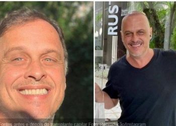 Ator Guilherme Fontes comemora transplante capilar: ‘estou realizado’