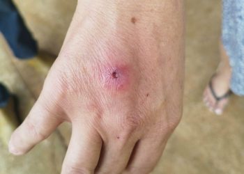 Saúde alerta sobre cuidados com a Esporotricose em Campo Mourão