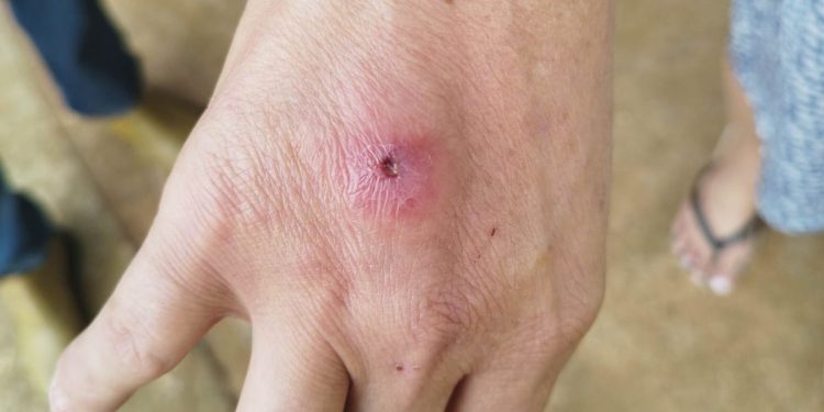 Saúde alerta sobre cuidados com a Esporotricose em Campo Mourão