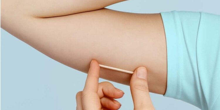 Campo Mourão disponibiliza novo método contraceptivo de longa duração nas Unidades Básicas de Saúde